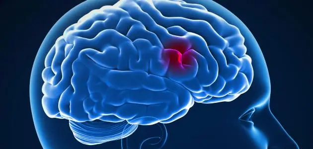 كيف تتعرف على أعراض جلطة الدماغ وتتصرف بشكل سريع؟
