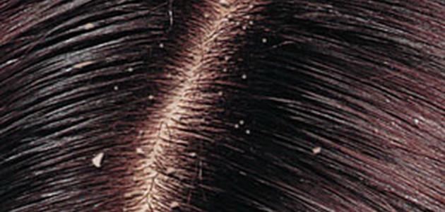 حلول فعالة لعلاج قشرة الشعر الموسمية