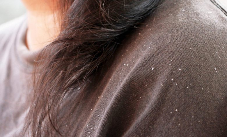 أسباب قشرة الشعر في الشتاء 1-429-780x470