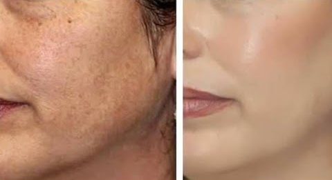 5 ماسكات لعلاج تصبغات الوجه وازالة البقع الداكنة