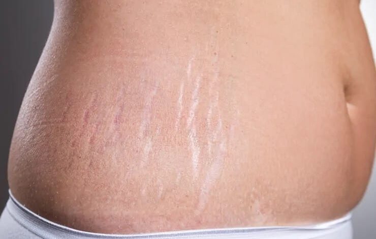 5 وصفات طبيعية لتقليل علامات تمدد الجلد