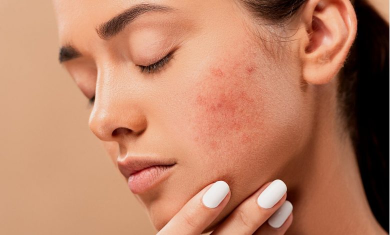 طرق علاج حب الشباب طبيعياً
