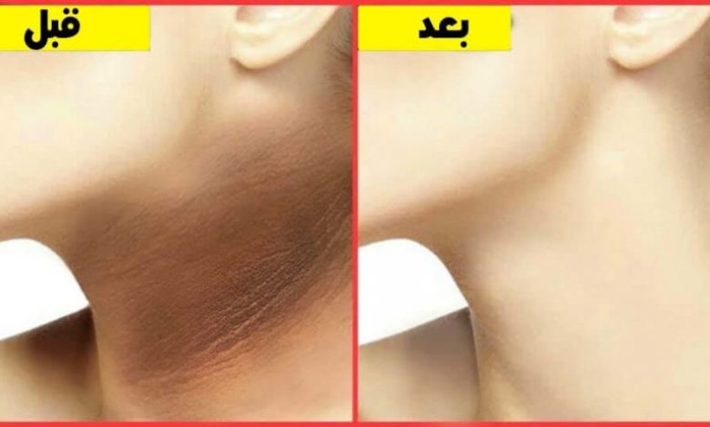 خلطة سحرية للتخلص من سواد الرقبة وتبييض وتفتيح الوجه