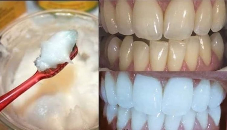 وصفة سحرية و فعالة لتبييض الأسنان بياضا ناصعا
