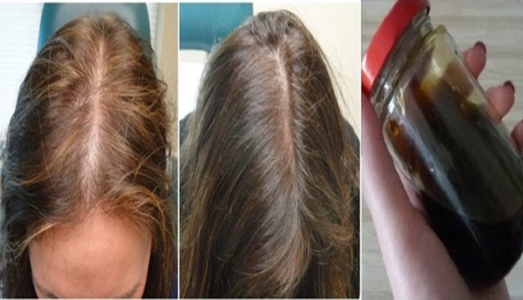 الوصفة المضمونة في تقوية الشعر وانبات الفراغات الأمامية