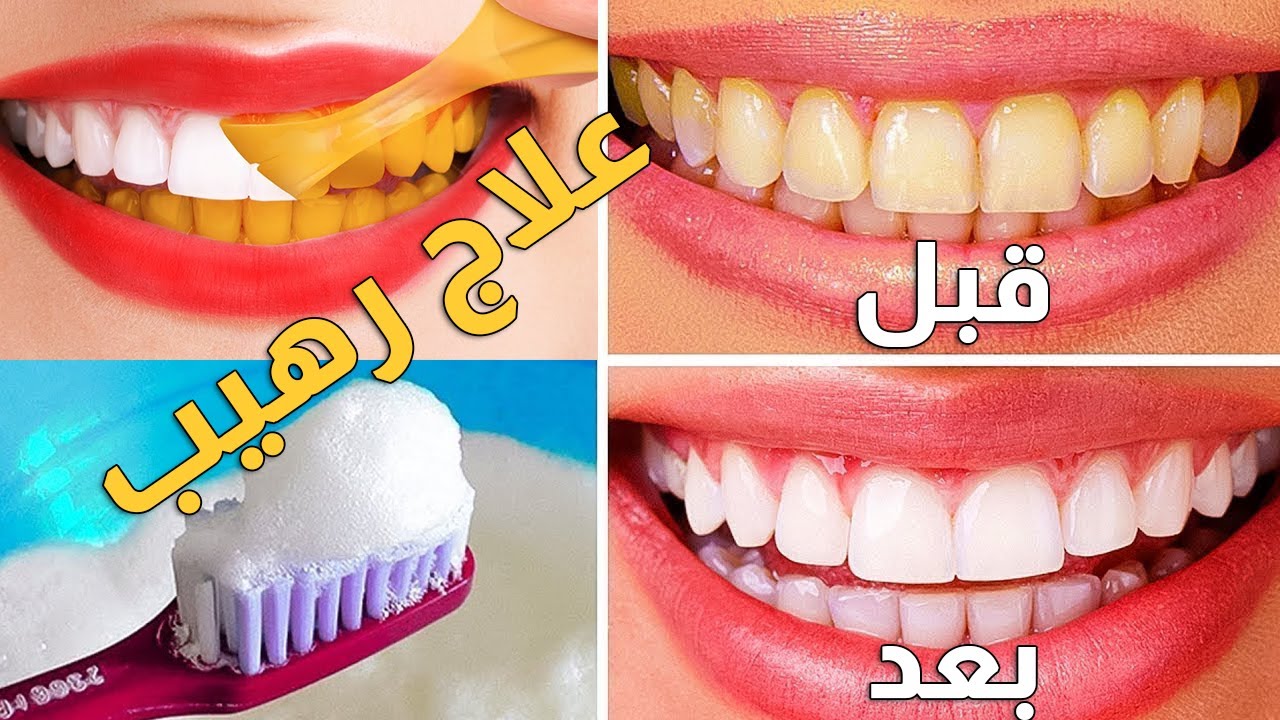 وصفة لتبييض الأسنان وإزالة الرائحة من الفم