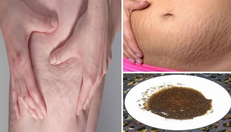 وصفة لعلاج الخطوط البيضاء بمكونات طبيعية