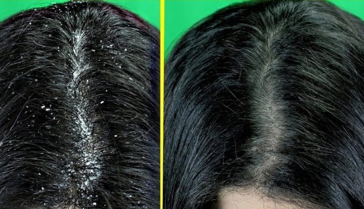 خلطات طبيعية للقضاء على القشرة من الشعر