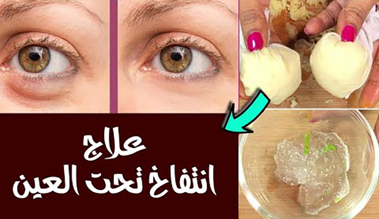أسهل طريقة لعلاج انتفاخ تحت العين