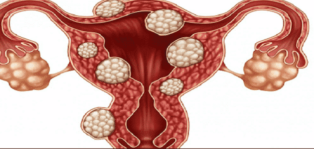 علاج التكيس في الرحم