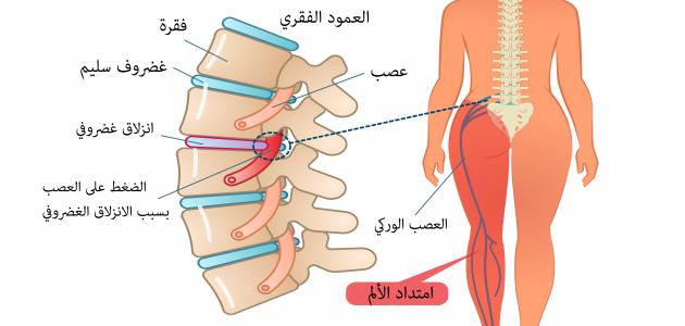 تشخيص عرق النسا وطرق علاجه بالتفصيل