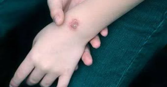 ما هي بكتيريا mrsa وطرق علاجها