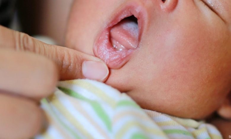 علاج فطريات الفم عند الاطفال وطرق الوقاية منها