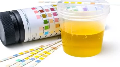 معلومات تفصيلية عن تحليل urine analysis