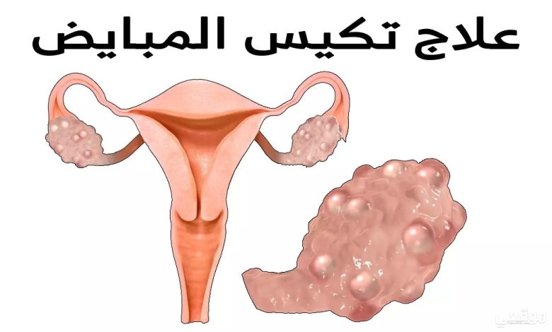 اعراض تكيس المبايض عالم حواء