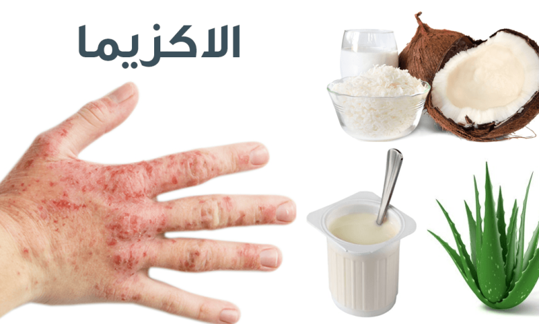 علاجات طبيعية للاكزيما