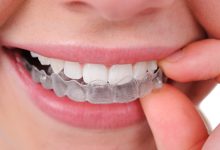 كيفية تنظيف تقويم الأسنان الشفاف .. ” ماذا يحدث اذا لم ينظف يوميًا ؟”