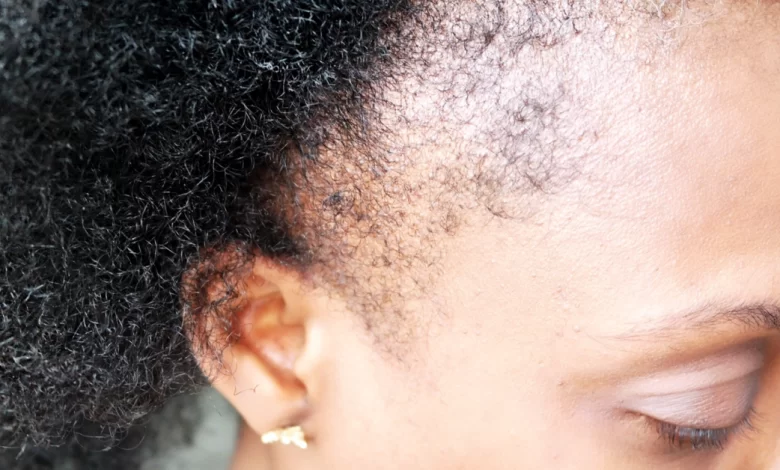 علاج تساقط الشعر بعد الولادة