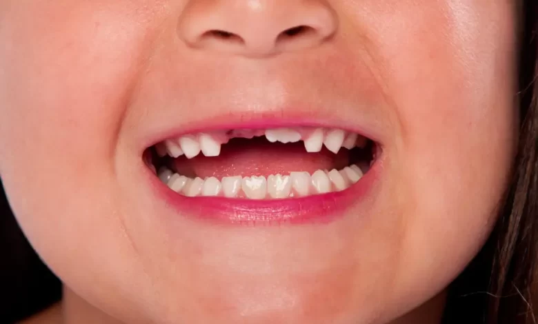 متى يبدأ الأطفال في فقدان أسنان الحليب