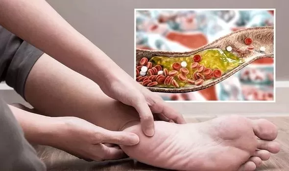 أعراض ارتفاع الكوليسترول عند النساء.. إليك طرق الكشف والوقاية