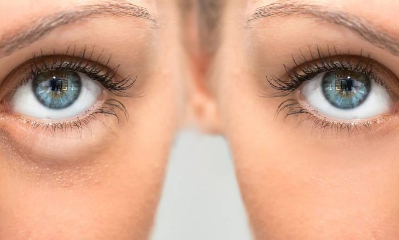 علاج انتفاخات العين بوصفات منزلية وطبية