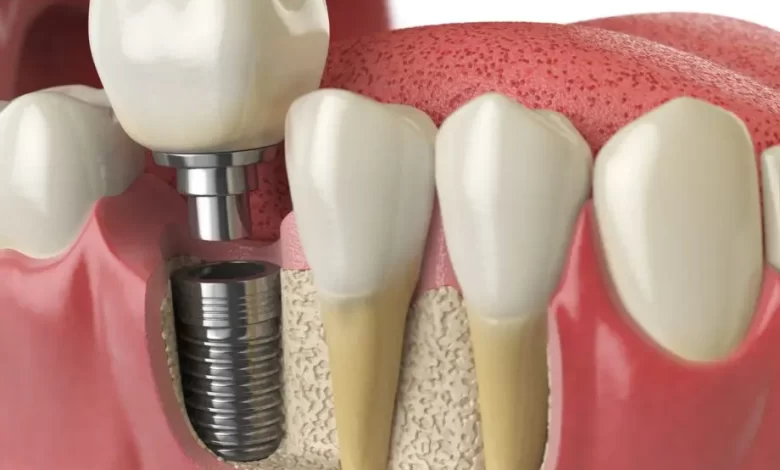 عملية زراعة الاسنان فوائدها ومخاطرها ونصائح للتعافي منها