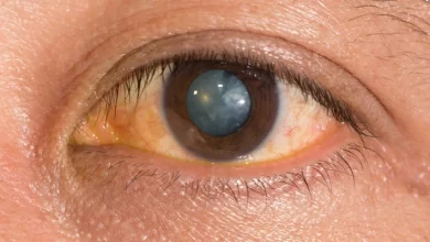 مضادات الأكسدة تحد من الإصابة بإعتام عدسة العين