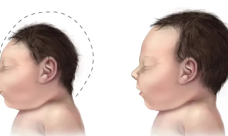 هل يمكن علاج صغر حجم الرأس عند الأطفال؟